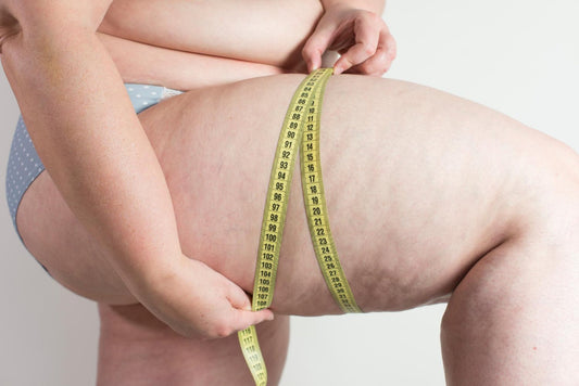 Lipödem Nedir? Görmezden Gelinen Kronik Bir Hastalık - Tight Tonic