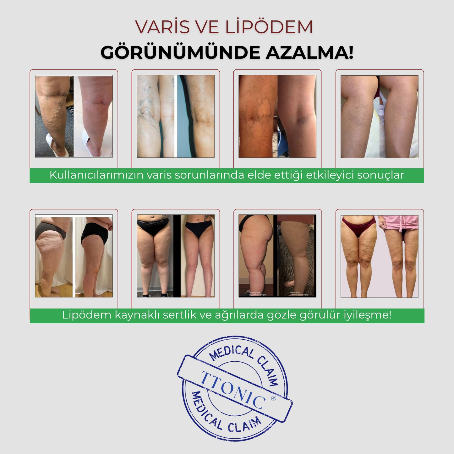 3'lü Etki Taytı Lipödem, Selülit, Varis TightTonic™