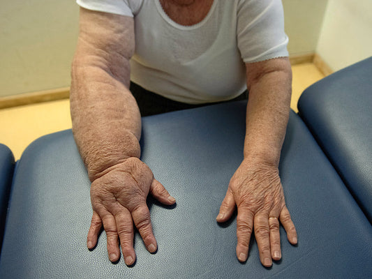 Şişlik ve Ağrıyla Yaşamak Zorunda Değilim – Lenfödemle Mücadelem