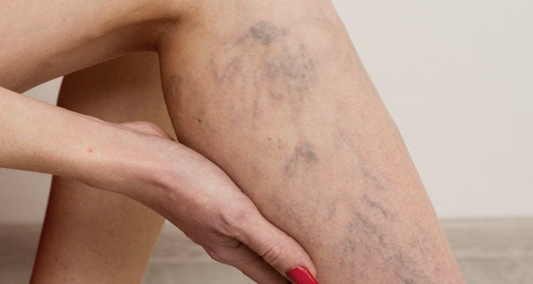 Bacaklarımda Damarlar Belirdikçe Güvenim Kayboldu… TightTonic™ ile Geri Kazandım - Tight Tonic