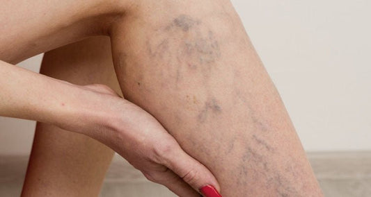 Bacaklarımda Damarlar Belirdikçe Güvenim Kayboldu… TightTonic™ ile Geri Kazandım - Tight Tonic