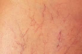 Bacaklarımda Mor Damarlar Çıkmaya Başlayınca Panikledim… İşte Çözüm Sürecim - Tight Tonic