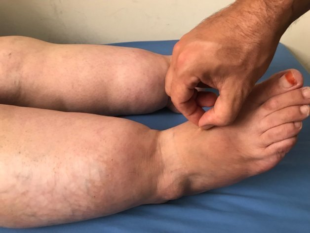 Doktor: “Kilo Vermen Yetmez” Dedi… Lipödem Gerçeğiyle Yüzleştiğim Gün - Tight Tonic