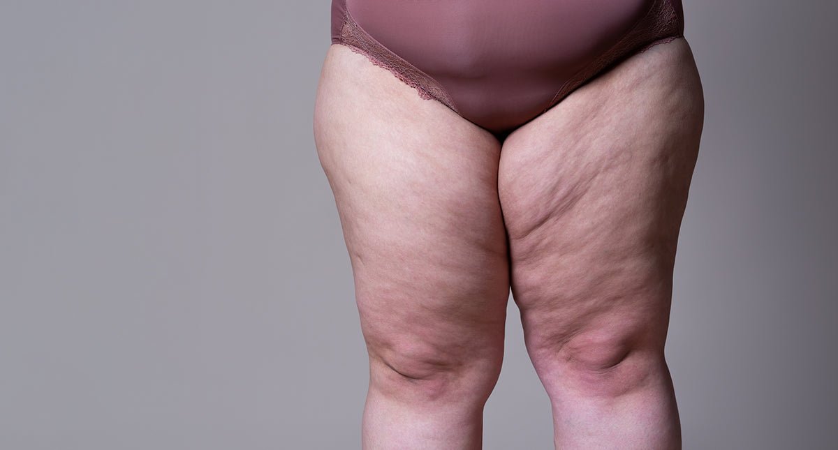 Kadınların %60’ı Yaşıyor Ama Kimse Konuşmuyor: Lipödem ve Dolaşım Sorunları - Tight Tonic