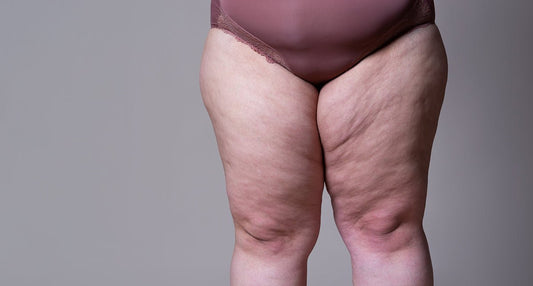 Kadınların %60’ı Yaşıyor Ama Kimse Konuşmuyor: Lipödem ve Dolaşım Sorunları - Tight Tonic