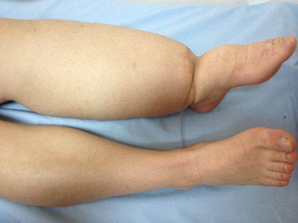 Kışın Ayaklarım Şişiyor, Bacaklarım Ağrıyordu… Meğer Lenfödemmiş - Tight Tonic