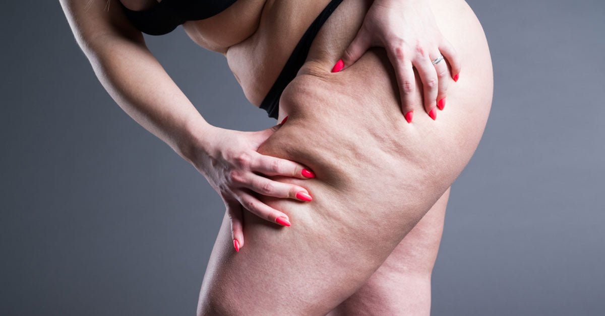 Lipödem Nedir? Belirtileri ve Evde Uygulanabilecek Çözümler - Tight Tonic