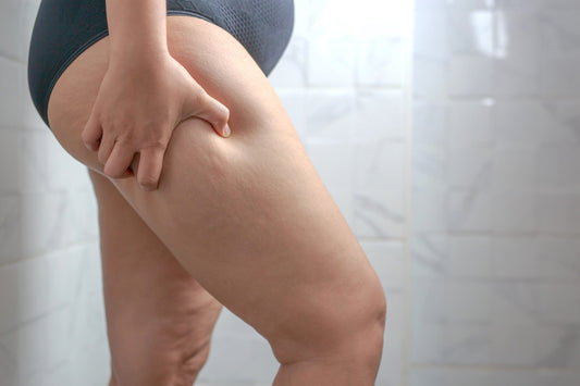 Lipödem ve Varis Aynı Anda Olur mu? Ne Yapmalıyım? - Tight Tonic