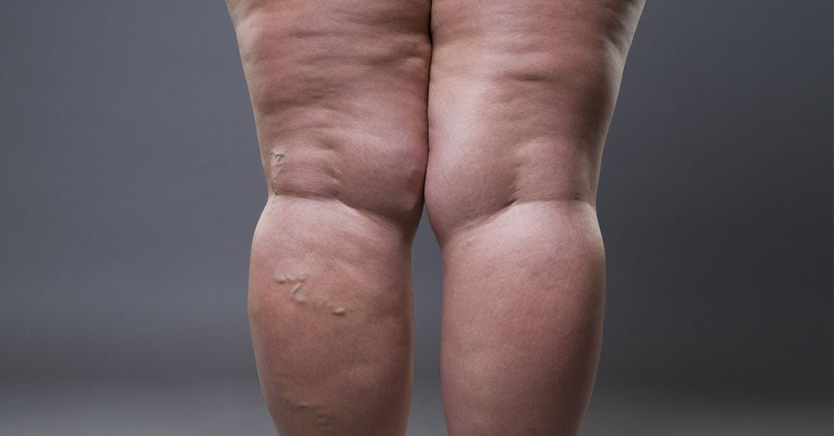 Lipödemli Bacaklar İçin Hangi Kompresyon Taytı Tercih Etmeliyim? - Tight Tonic