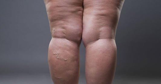 Lipödemli Bacaklar İçin Hangi Kompresyon Taytı Tercih Etmeliyim? - Tight Tonic