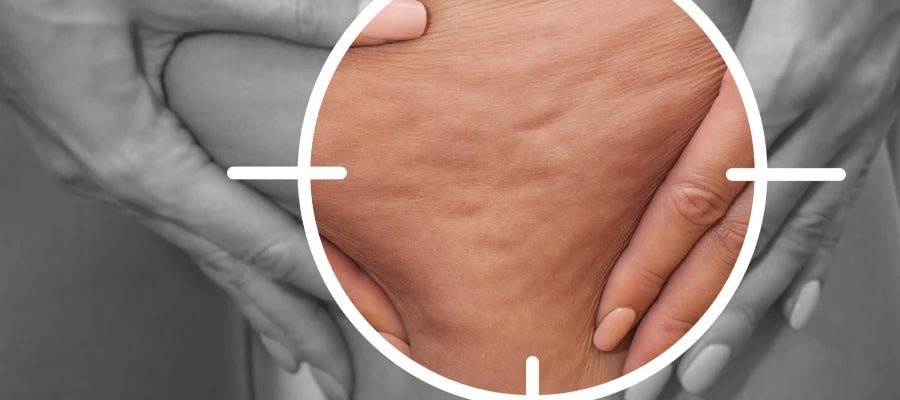Selülit Nedir? Selülit Neden Olur ve Nasıl Geçer? - Tight Tonic