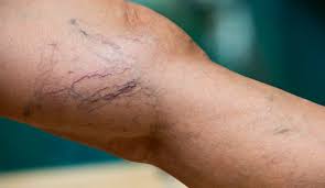 Varis Ağrısıyla Uyanmak Nasıl Bir His Biliyor musun? - Tight Tonic