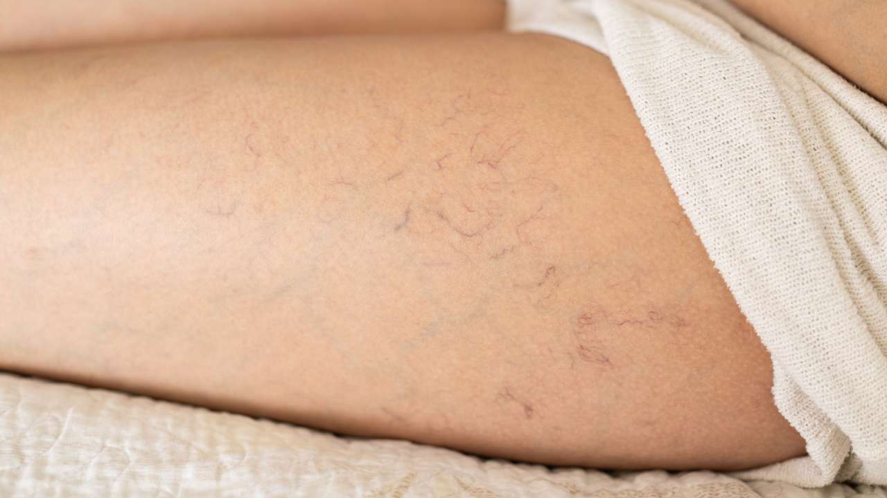 Yalnız Değilsin: Lipödem ve Varisle Savaşan Binlerce Kadının Hikayesi - Tight Tonic