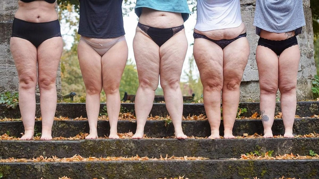 Yıllarca Kilo Sandılar… Meğer Sorunum Lipödemmiş - Tight Tonic