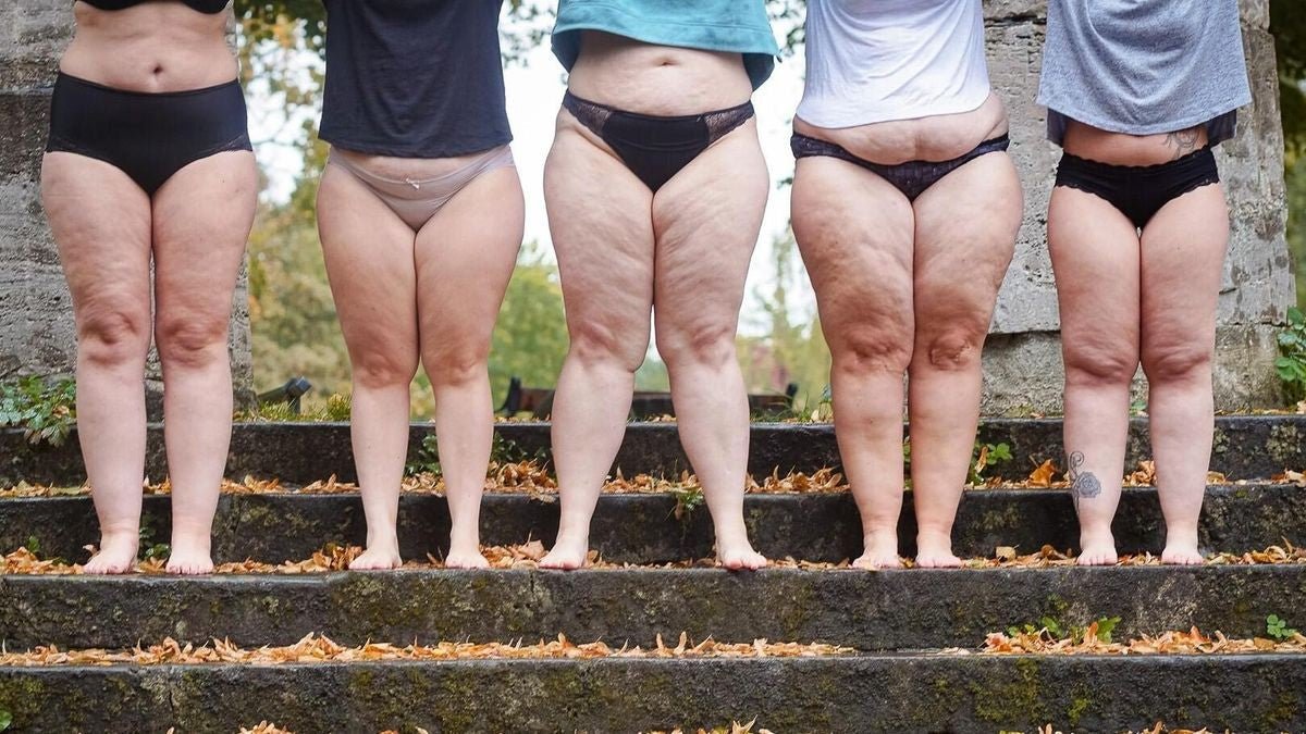 Yıllarca Kilo Sandılar… Meğer Sorunum Lipödemmiş - Tight Tonic