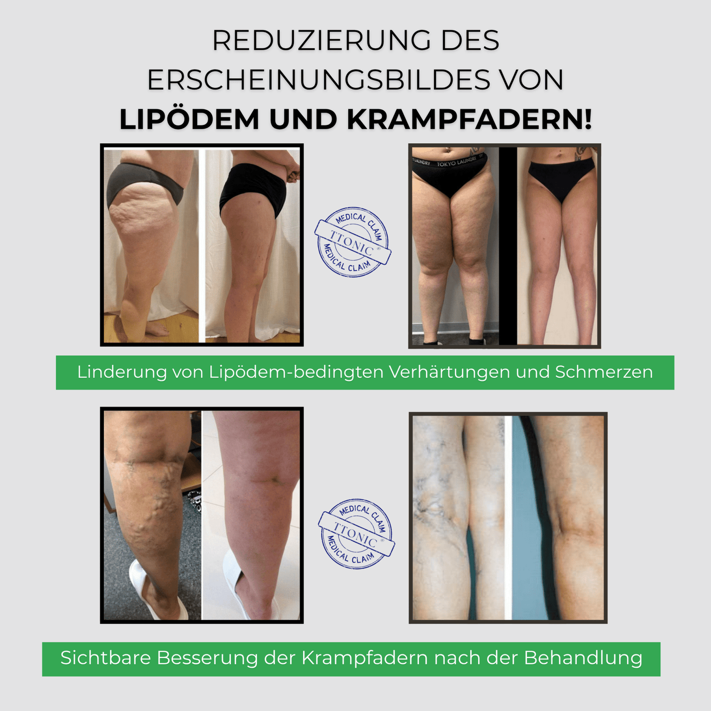 3 Fach Wirkungs Leggings Lipödem, Cellulite, Krampfadern TightTonic™ - Tight Tonic