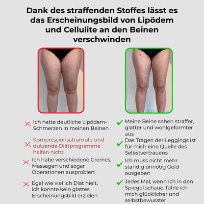 3 Fach Wirkungs Leggings Lipödem, Cellulite, Krampfadern TightTonic™ - Tight Tonic